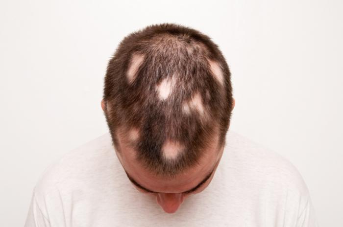 Read more about the article What is Alopecia?