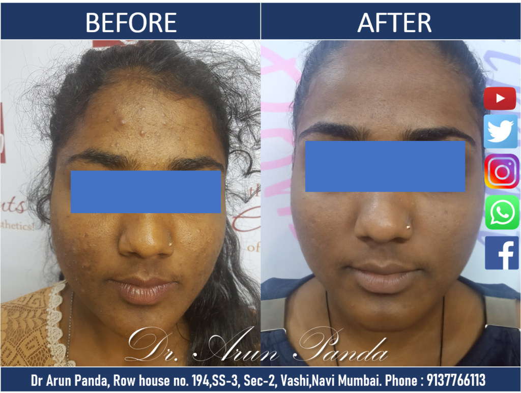 Pimple Treatment in Navi Mumbai