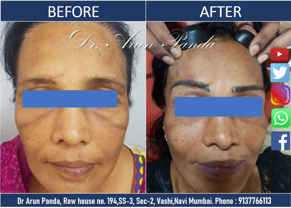 Eyebrow Micropigmentation Treatment Cost and Full Procedure for permanent makeup in Navi Mumbai