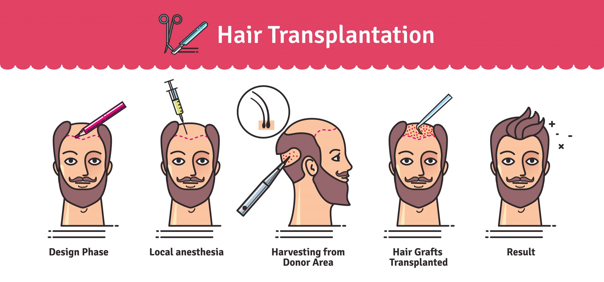 Read more about the article What is the Process for Hair Transplant?