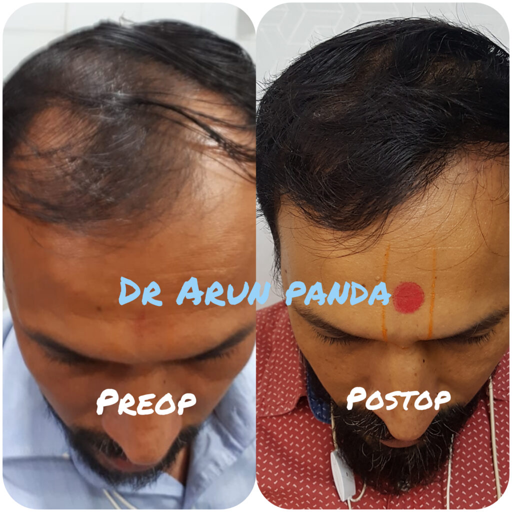 Before and After Hair Transplant - Male Patient 8 in Navi Mumbai
