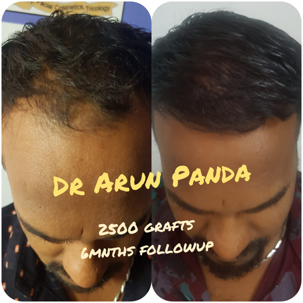 Male Hair Transplant in Navi Mumbai - Patient 9 Before and After