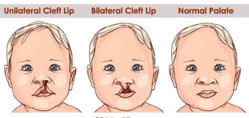 Cleft Lip And Palate Treatment in Navi Mumbai