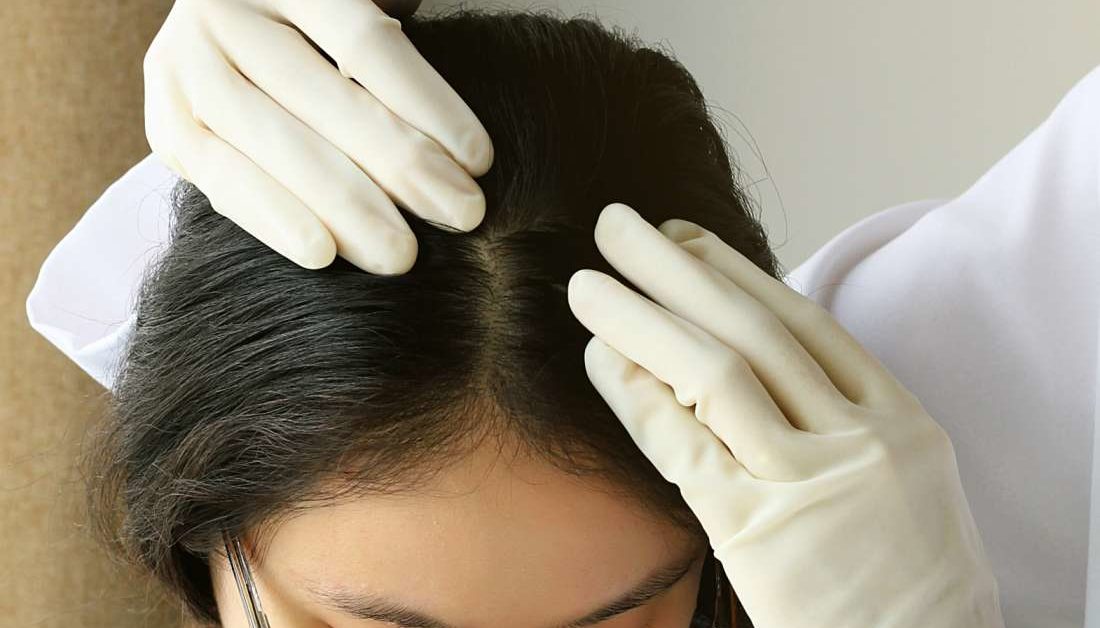 Can Haircare products cause Acne?