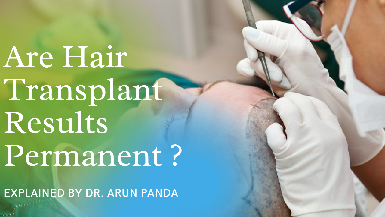 You are currently viewing Are Hair Transplant Results Permanent? Will my Hair Fall again after Hair Transplant with Dr. Panda
