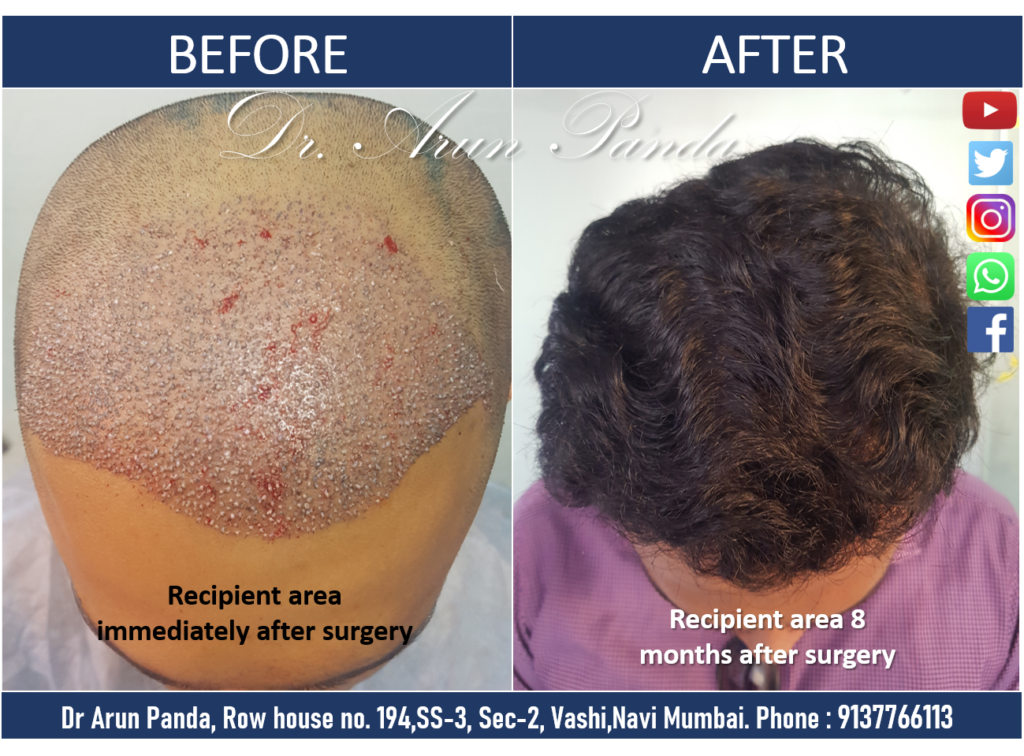 Navi Mumbai Hair Transplant Success - Male Patient 3 Before and After