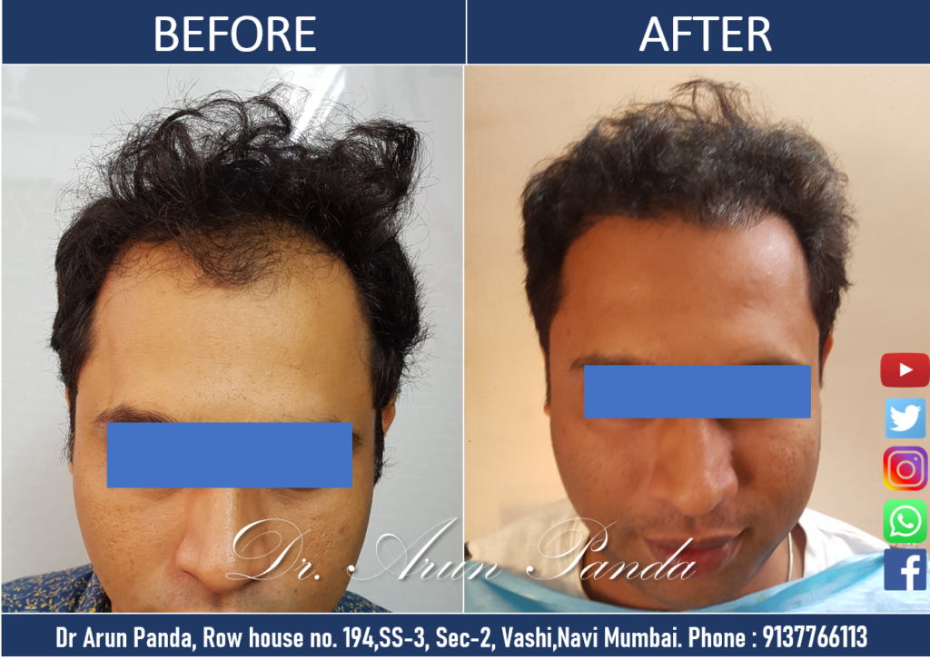 Navi Mumbai Hair Transplant: Male Patient Before and After Transformation