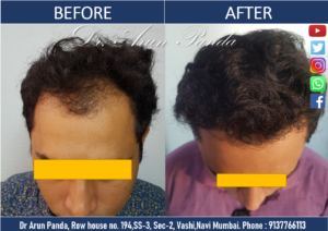 Read more about the article Hair Transplant Patient from Navi Mumbai sharing his experience and Hair Transplant Results in Navi Mumbai