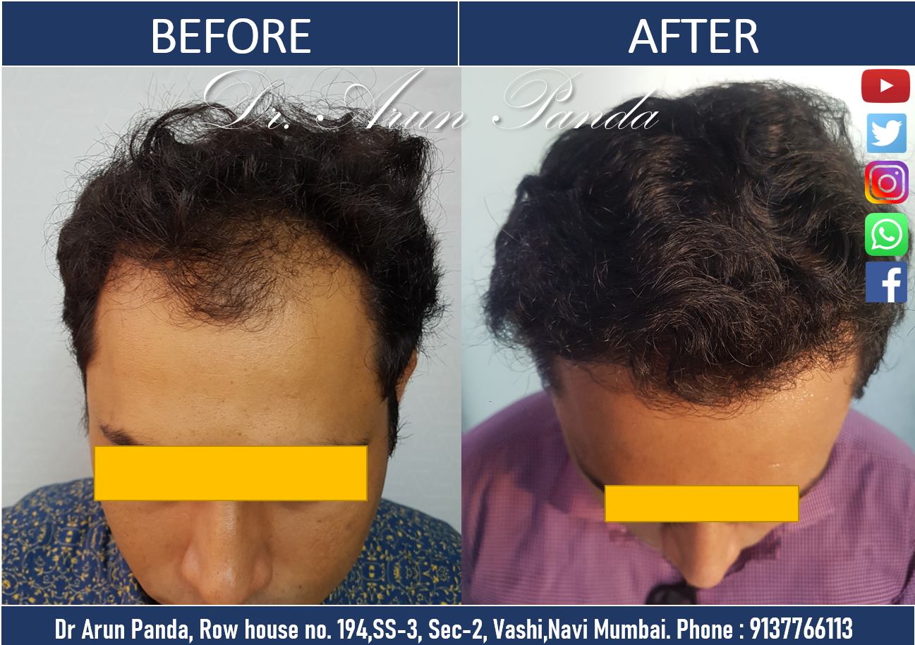 You are currently viewing Hair Transplant Patient from Navi Mumbai sharing his experience and Hair Transplant Results in Navi Mumbai