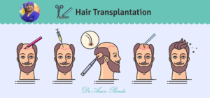 Read more about the article How is Hair Transplant performed in Navi Mumbai?