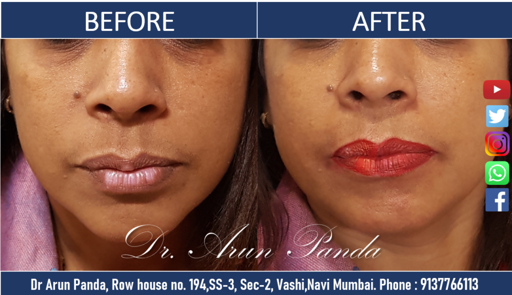 Lip Enhancement Treatment in Navi Mumbai