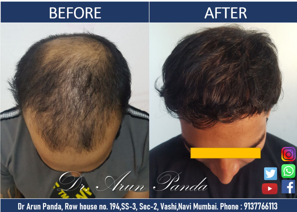 Before and After Hair Transplant Results - Patient in Navi Mumbai