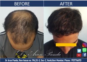 Read more about the article Hair Transplant Navi Mumbai Patient’s 100% Success Rate