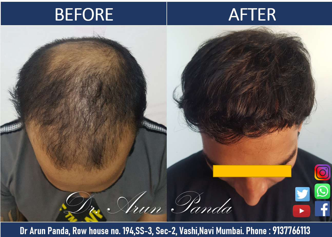 You are currently viewing Hair Transplant Navi Mumbai Patient’s 100% Success Rate