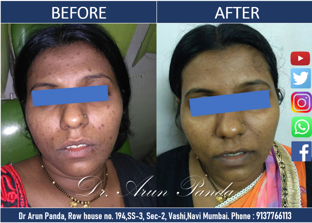 Skin Whitening Treatment in Navi Mumbai