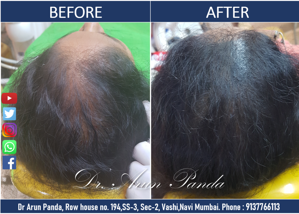 Male Patient 5 - Before and After Hair Transplant in Navi Mumbai