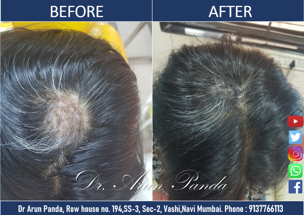 Male Hair Transplant in Navi Mumbai - Patient 4 Before and After