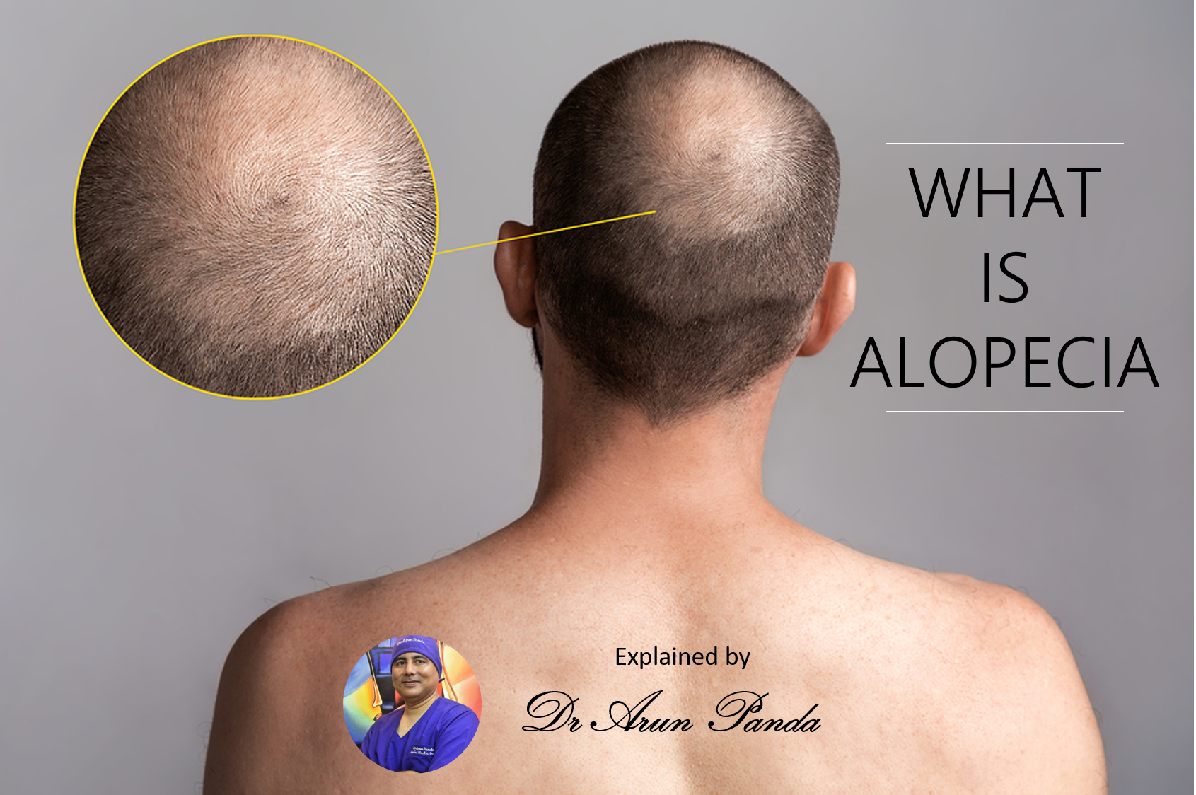You are currently viewing What is Alopecia? Hair Fall Treatment in Navi Mumbai