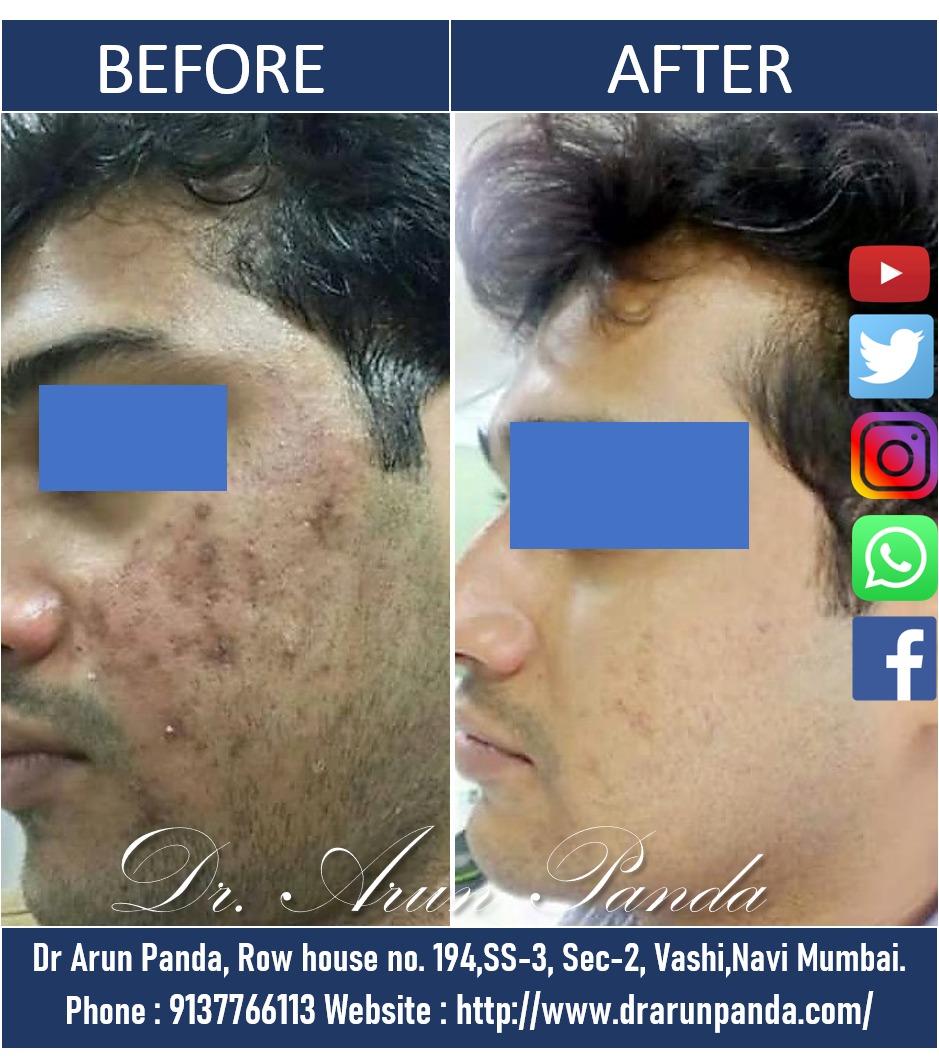 Read more about the article Acne Treatment & Acne Scars Removal in Navi Mumbai