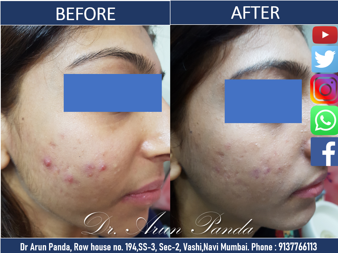 Read more about the article Acne and Pimple Doctor in Vashi, Navi Mumbai