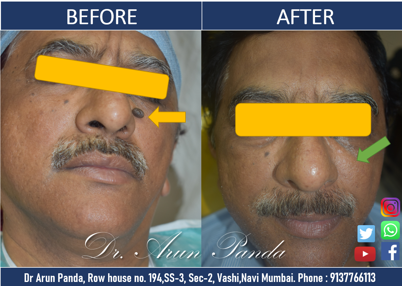 Read more about the article Mole Removal Treatment in Navi Mumbai by Certified Dermatologist