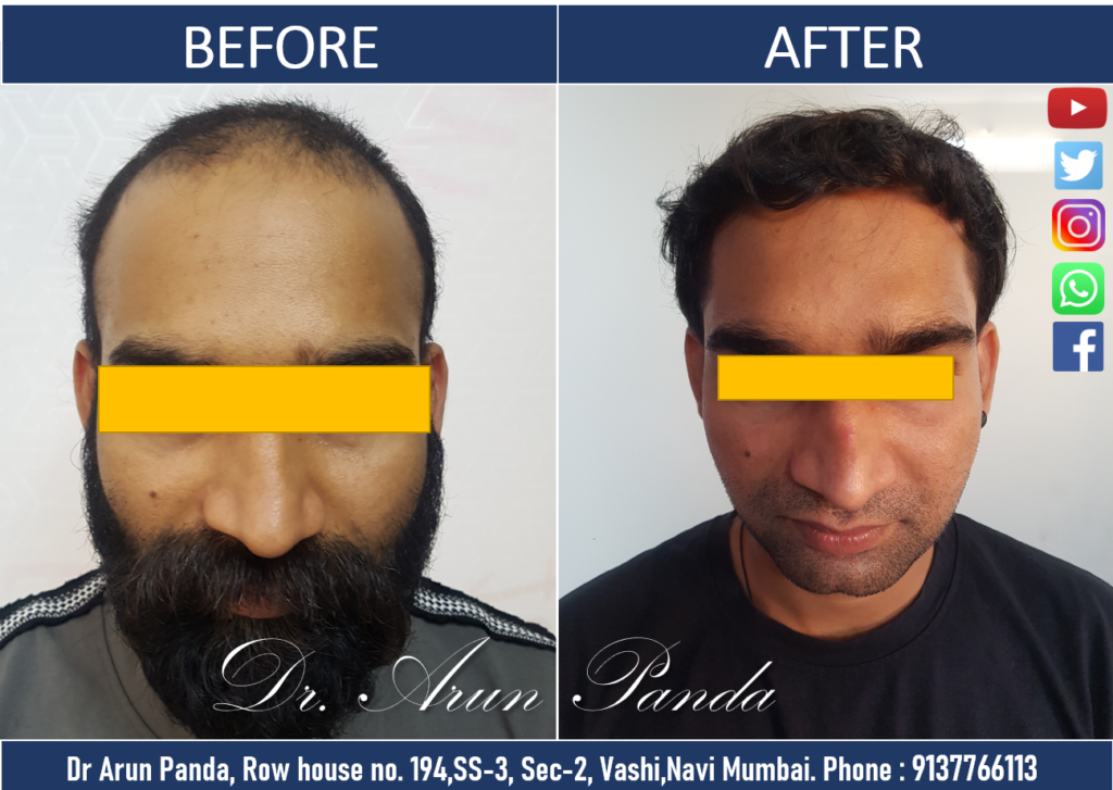 Best Hair Transplant Results in Navi Mumbai,Mumbai