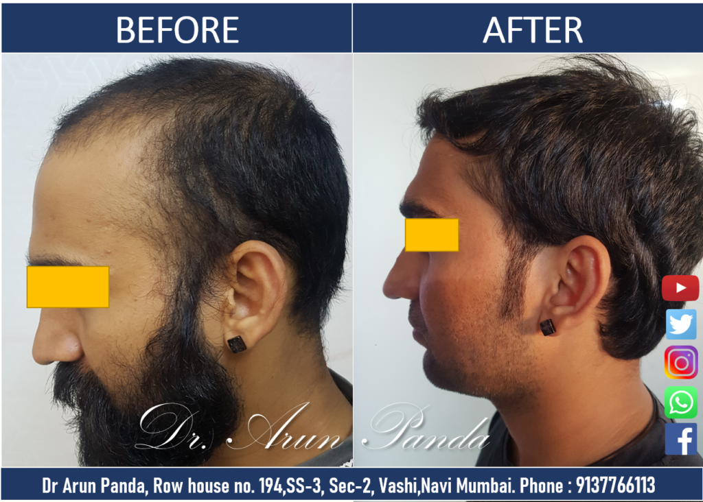 Best Before After Hair Transplant Results