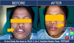 Read more about the article Cleft Repair Surgery in Navi Mumbai