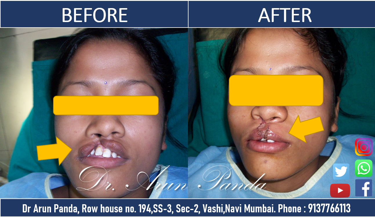 You are currently viewing Cleft Repair Surgery in Navi Mumbai