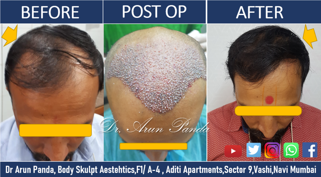 Before and After Hair Transplant - Male Patient 6 in Navi Mumbai