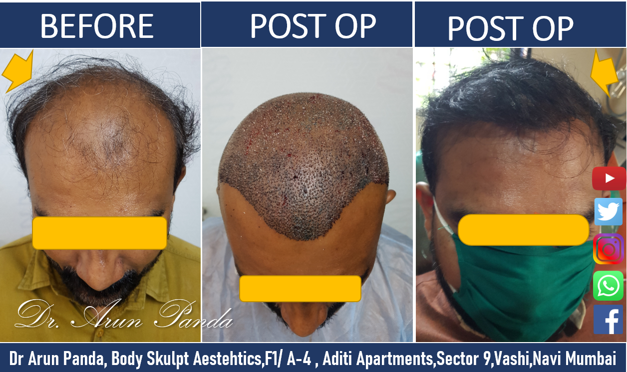 You are currently viewing CAUSES OF HAIR LOSS IN DETAIL | HAIR TRANSPLANT IN NAVI MUMBAI