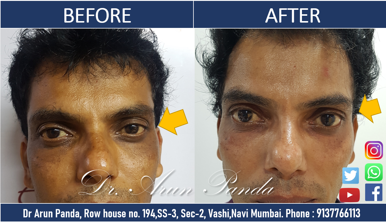 You are currently viewing AESTHETIC TREATMENT PATIENT TESTIMONIAL SAYS DR PANDA IS THE BEST SKIN SPECIALIST IN NAVI MUMBAI