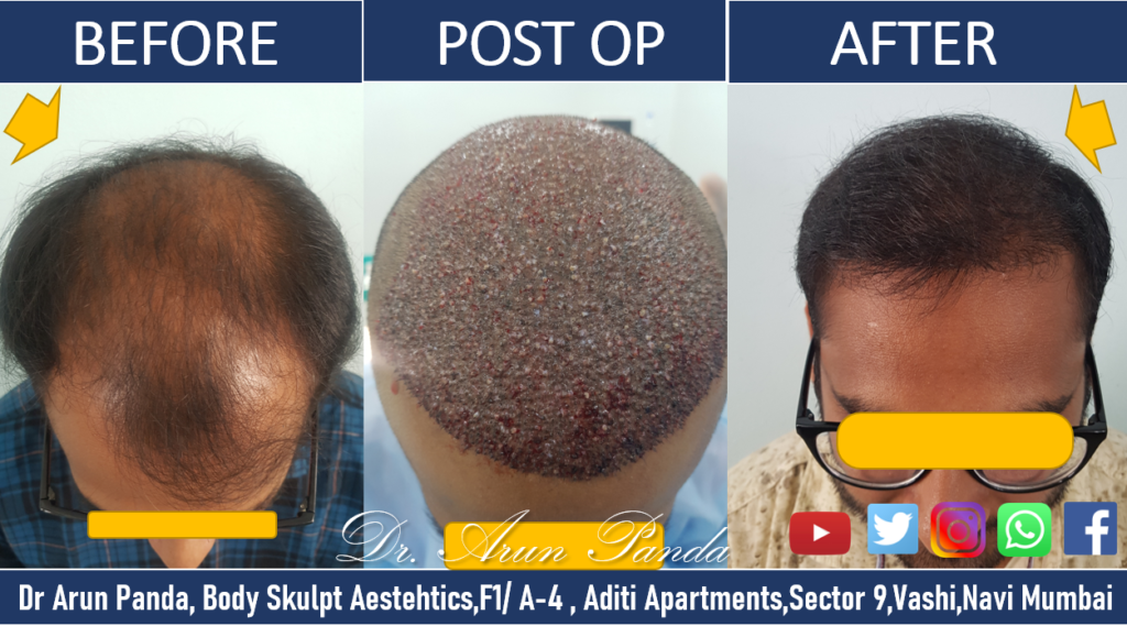 Male Hair Transplant Results Navi Mumbai - Patient 7 Before and After