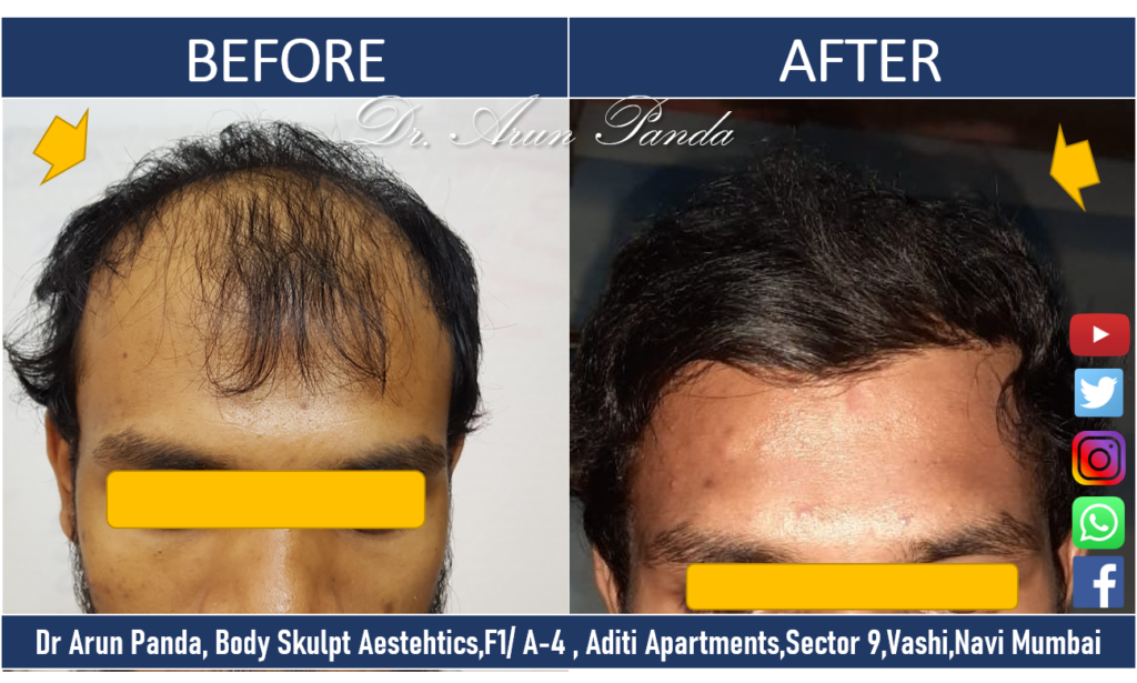 Before and After Hair Transplant - Male Patient 10 in Navi Mumbai