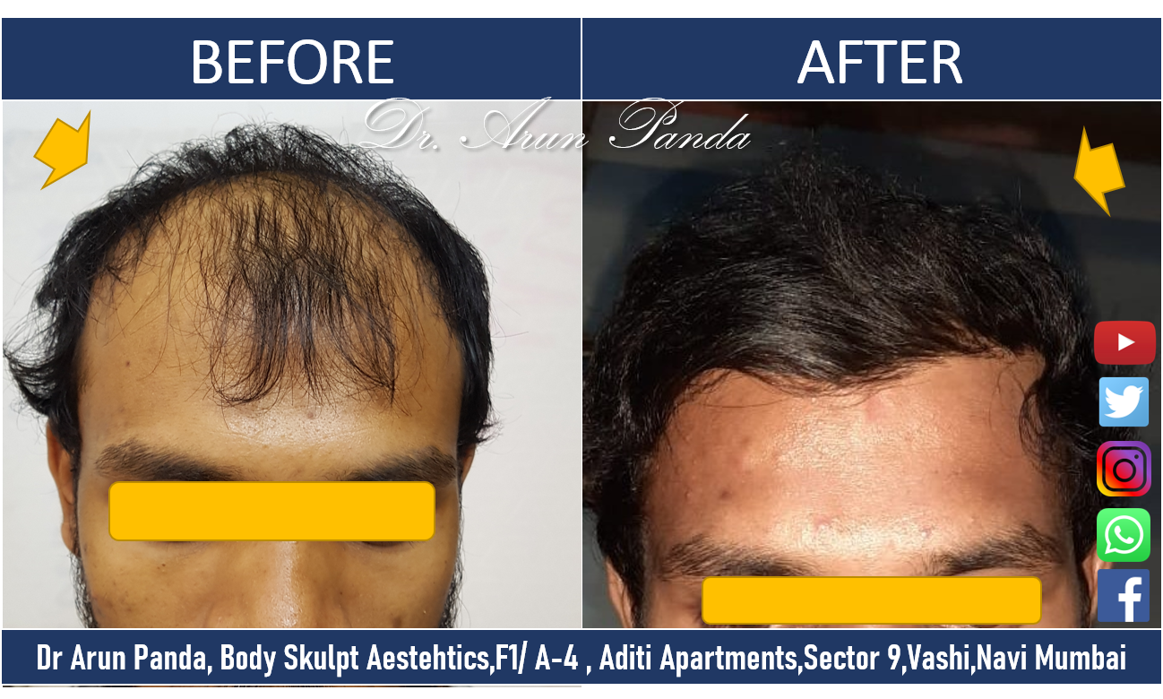 Best Hair Transplant in Navi Mumbai Dr Arun Panda