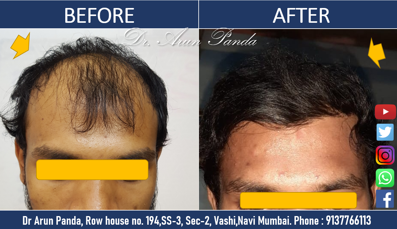 biofibre hair transplant cost in mumbai | Dr Arun Panda