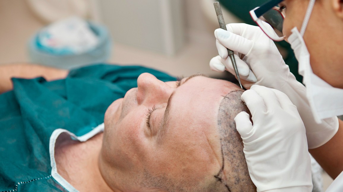 You are currently viewing How to find the Best Hair Transplant Surgeon in Navi Mumbai