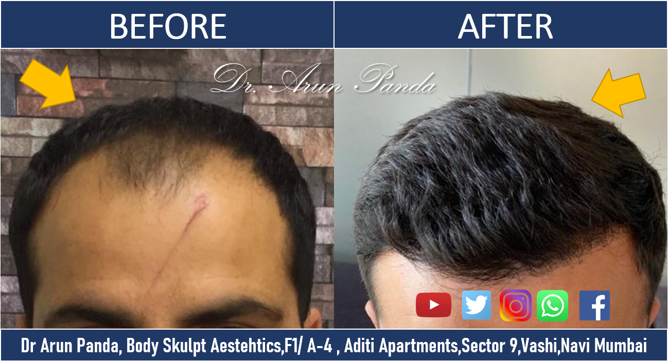 High-density Hair Transplantation Navi Mumbai