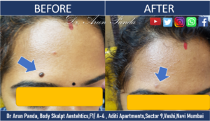 Read more about the article MOLE REMOVAL : DIAGNOSIS AND TREATMENT IN NAVI MUMBAI