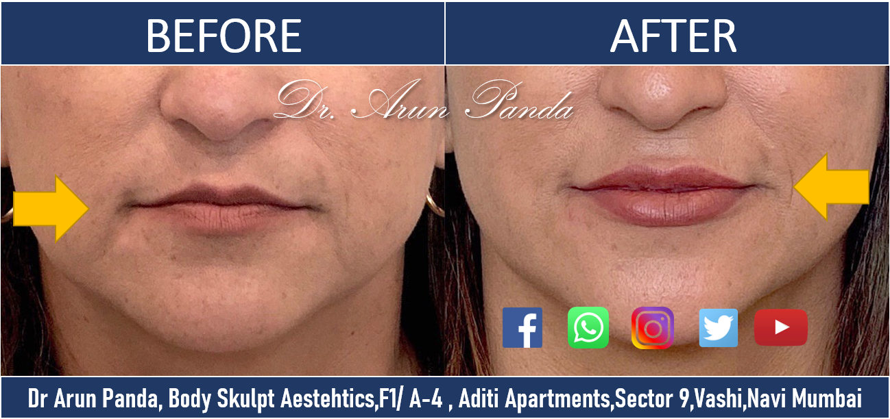 You are currently viewing Lip Fillers Treatment in Navi Mumbai– Cost, Procedure, Discount