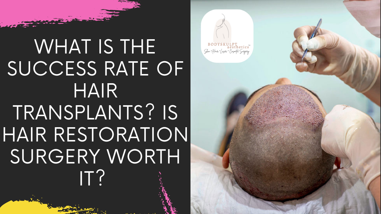 Read more about the article WHAT IS THE SUCCESS RATE OF HAIR TRANSPLANTS? IS HAIR RESTORATION SURGERY WORTH IT IN INDIA?