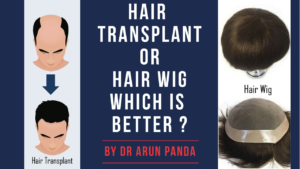 Read more about the article HAIR TRANSPLANT OR WIG WHICH IS BETTER FOR YOU