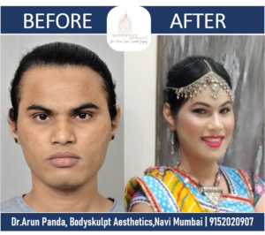 Read more about the article Facial Feminization Surgery in India by Top Facial Plastic Surgeon