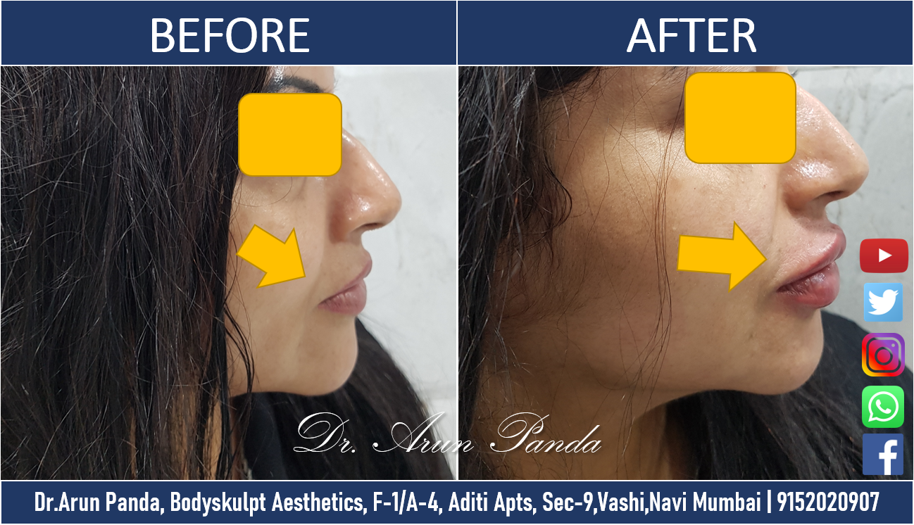 Lip Augmentation cost in Navi Mumbai