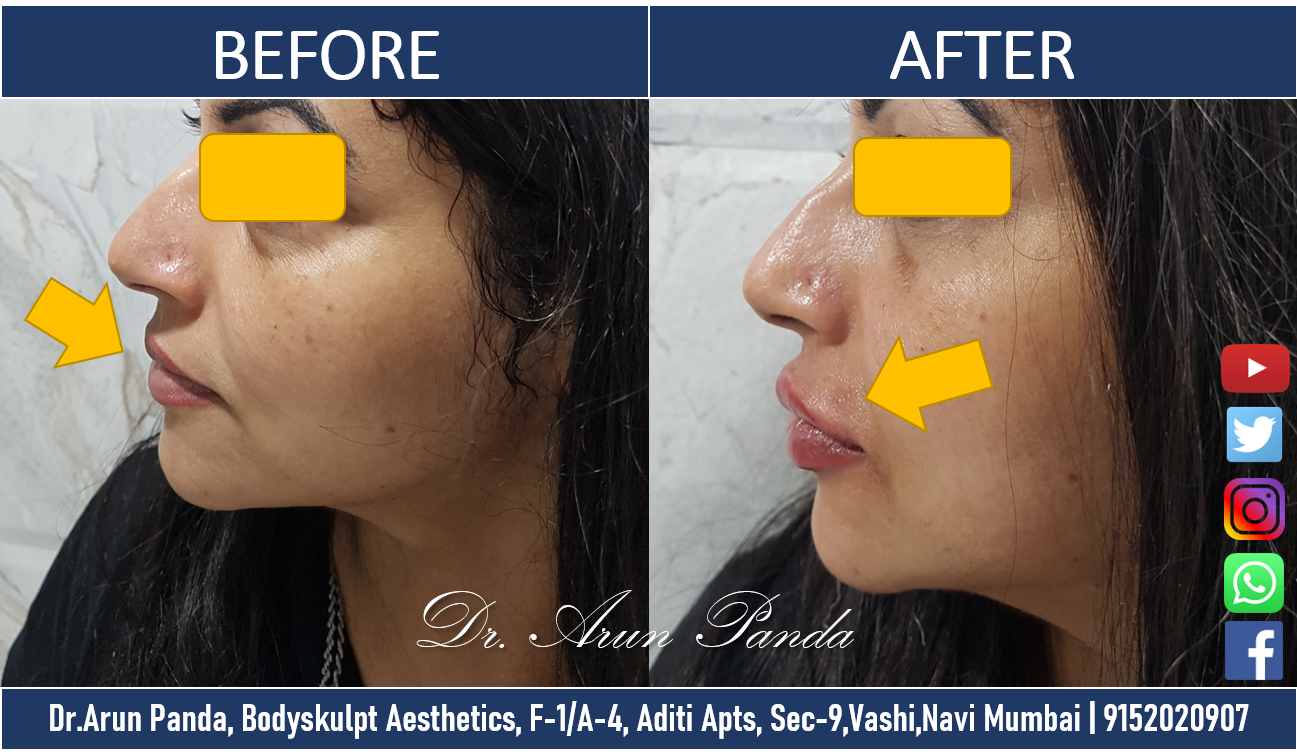 You are currently viewing Lip Filler Treatment in Navi Mumbai at Bodyskulpt Aesthetics the best.