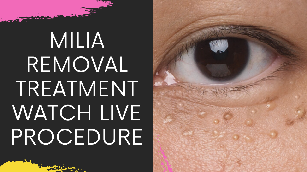 Read more about the article Milia Removal Treatments In Navi Mumbai | Milia Eyelid | Milia Eyelash | Milia Face Treatment