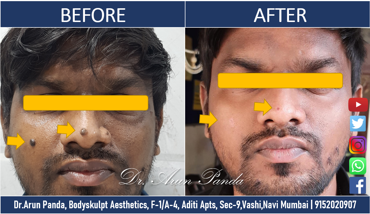 You are currently viewing Best Mole Removal Clinic in Navi Mumbai How to get rid of mole in one hour