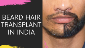 Read more about the article Beard & Moustache Hair Transplantation in Navi Mumbai, India