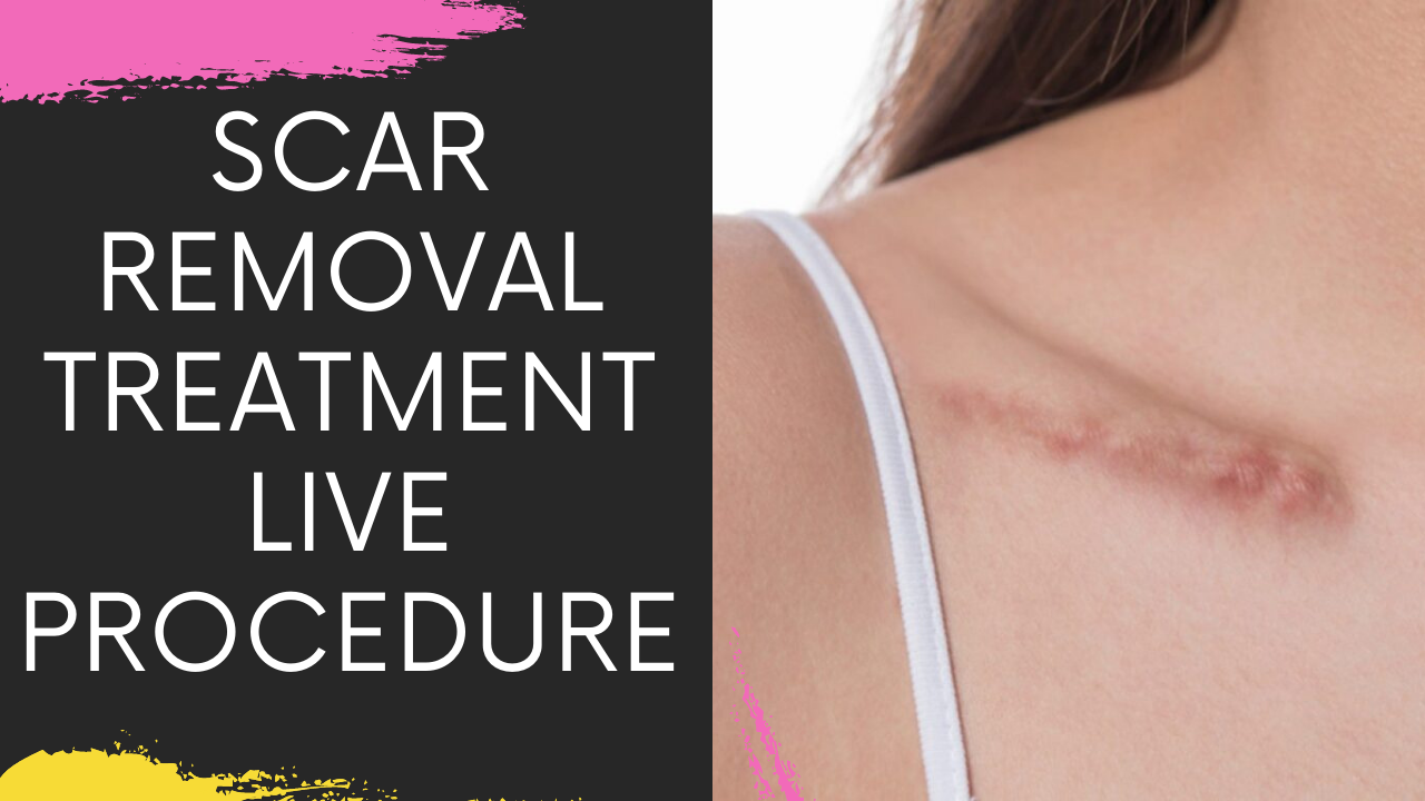 You are currently viewing Dermabrasion for Scar removal live surgery | Scar Removal Treatment in Navi Mumbai by Facial Surgeon