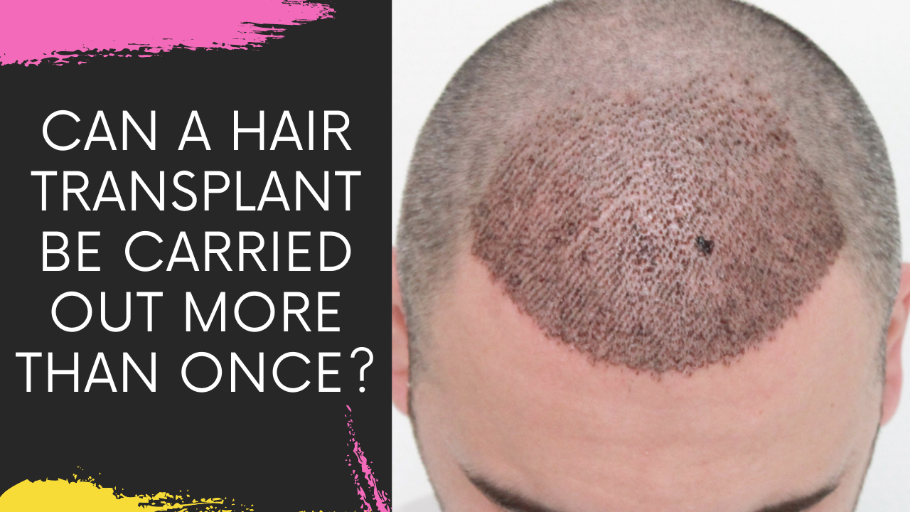 Can Hair Transplant Surgery be performed twice on the same patient if the